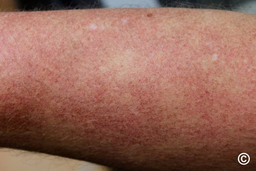 Red spots on the skin Fine red dots and diffuse redness on limb skin, typical of capillaritis or small-vessel inflammation.