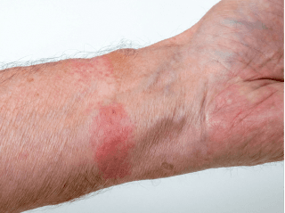 Localized red, circular skin lesion on a wrist /images/dermatitis/trail-8.png